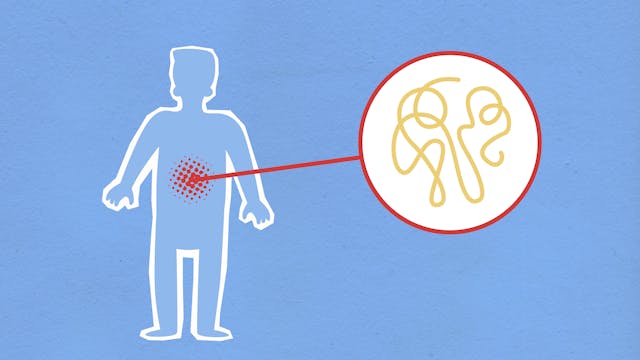 מה זה נגע היפודנסי (Hypodense lesion)