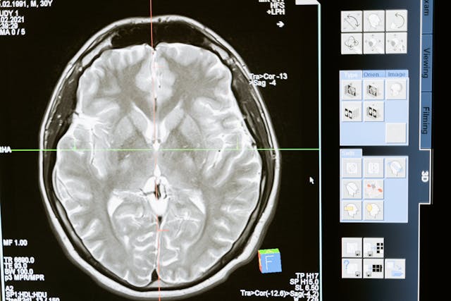 Read more about the article ממצאים נפוצים בפענוח MRI מוח